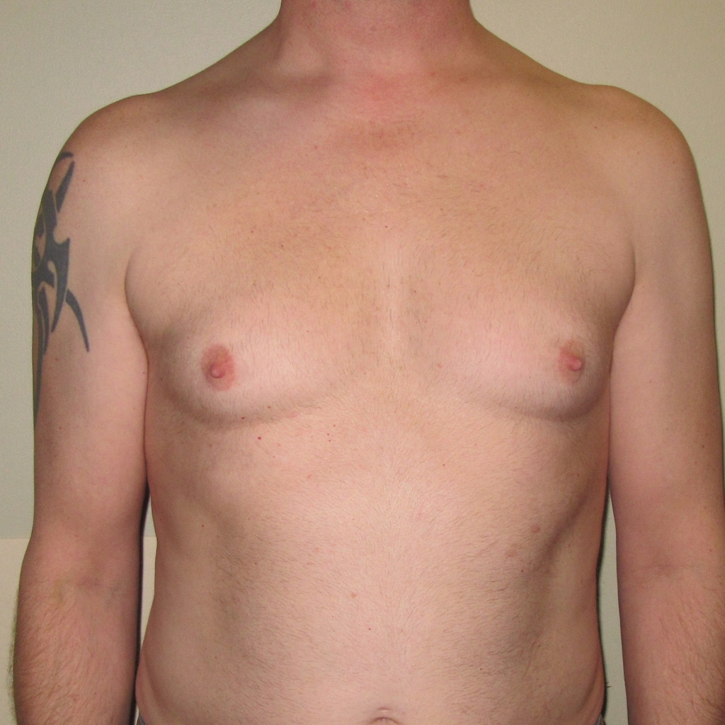 Gynaecomastia correction Adnova Clinic