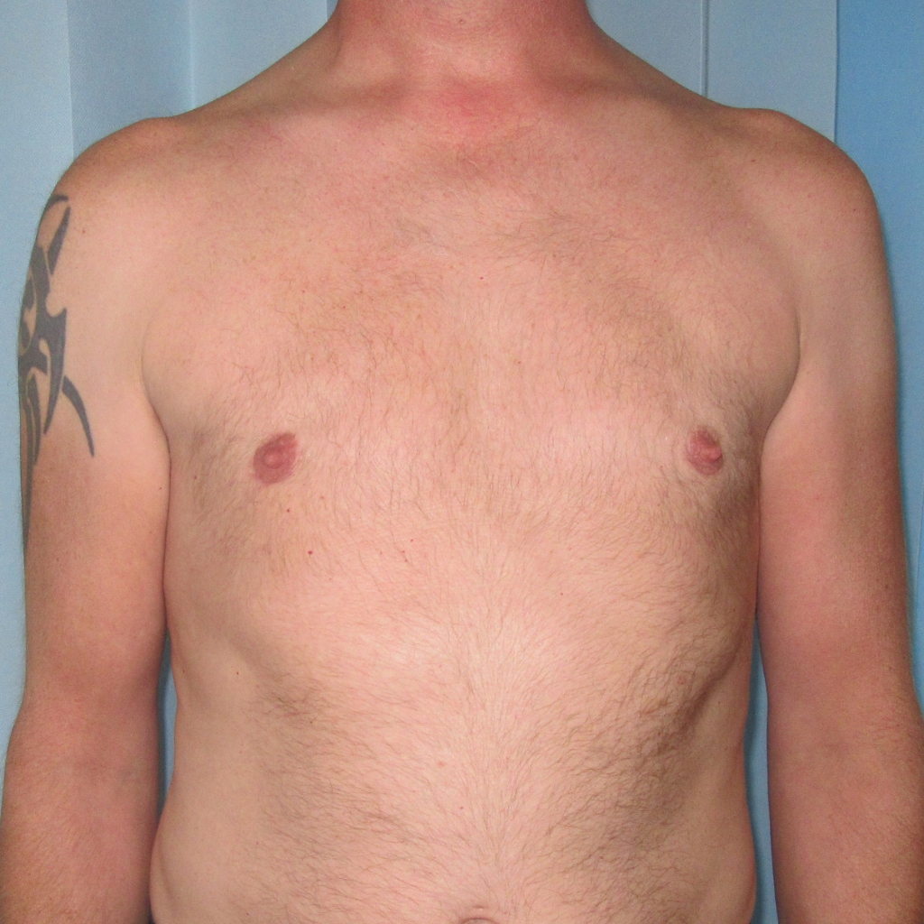 Gynaecomastia surgery