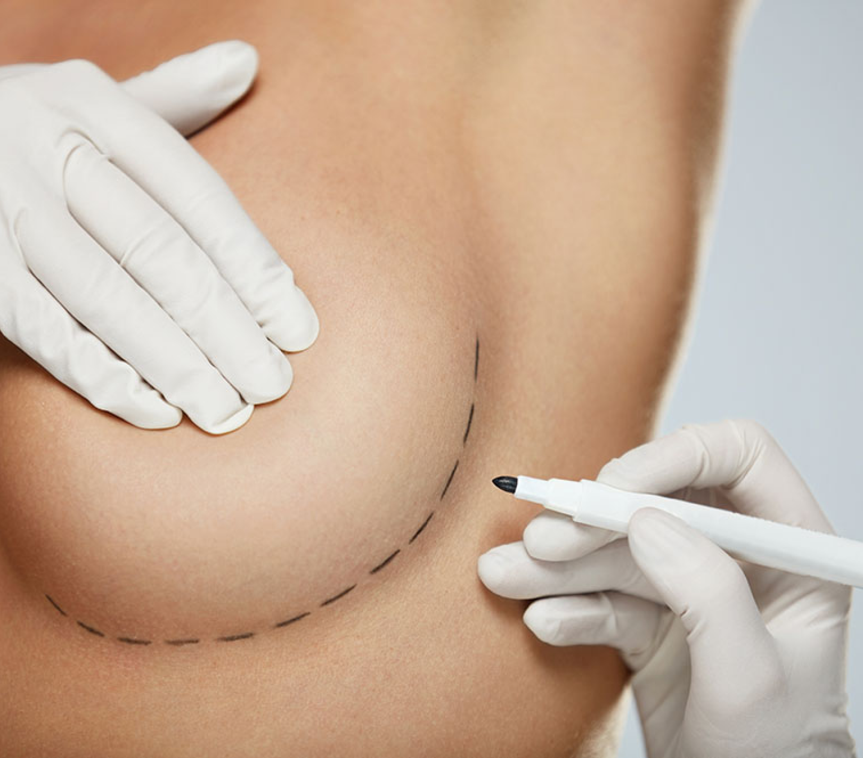 A surgeon marking breast before treatment