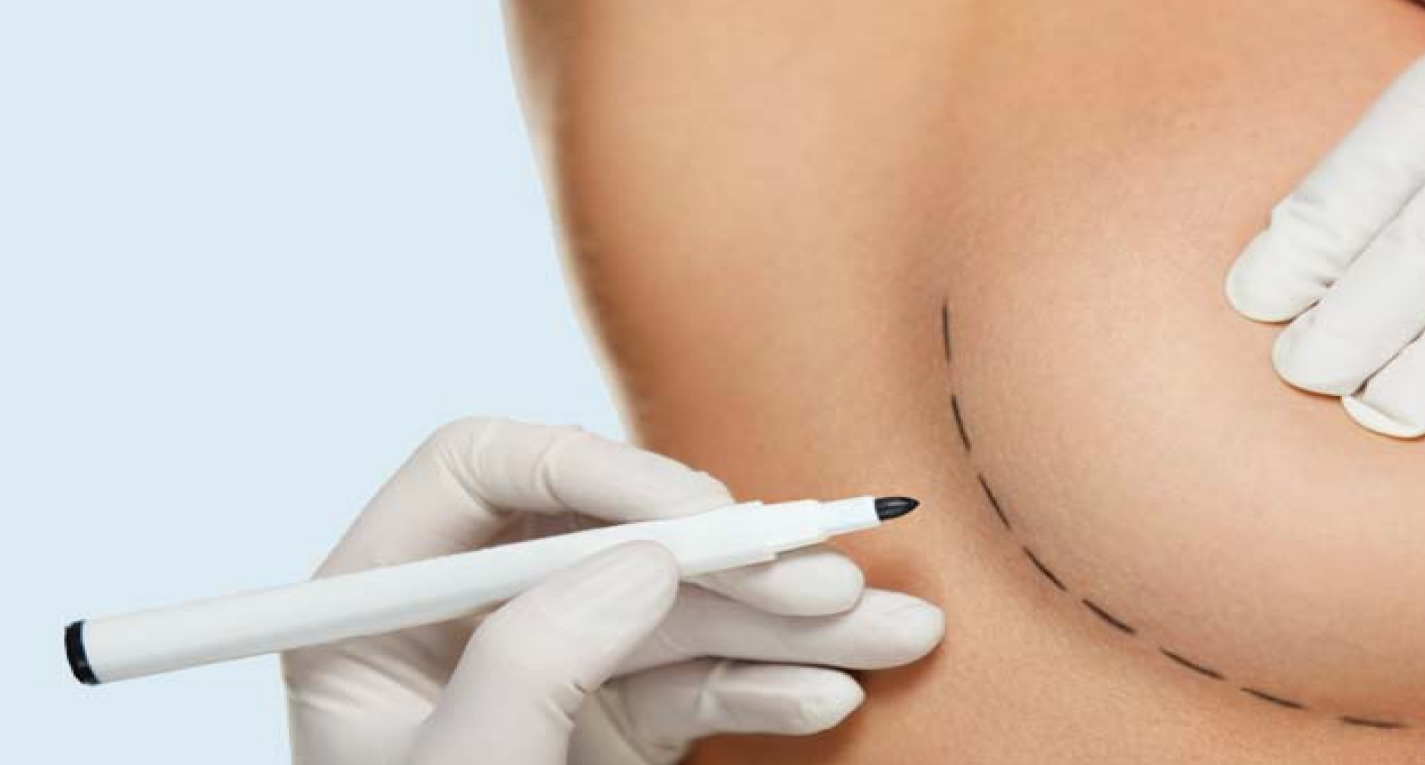 Body marked for breast procedure