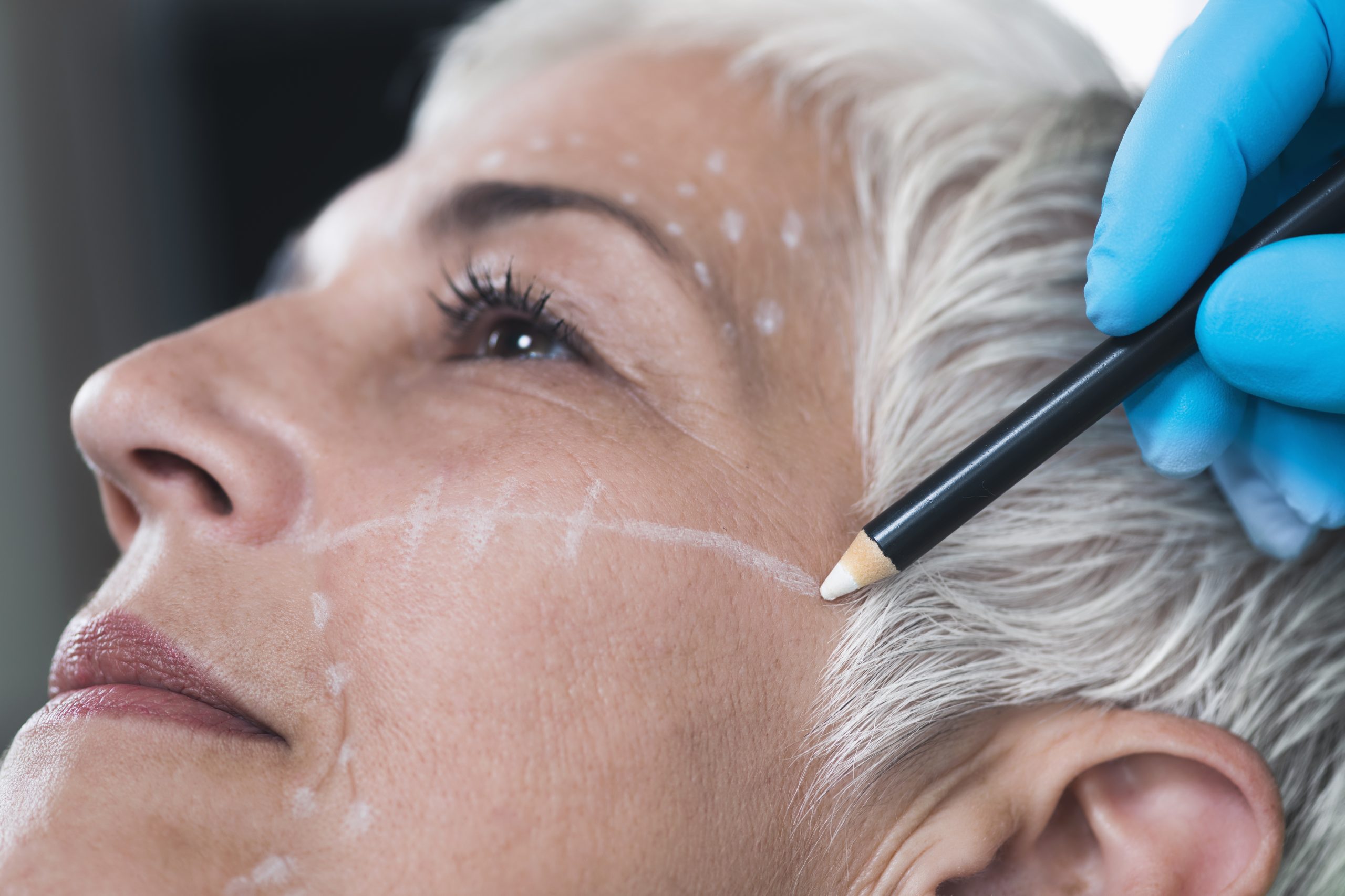 key differences in facelifts