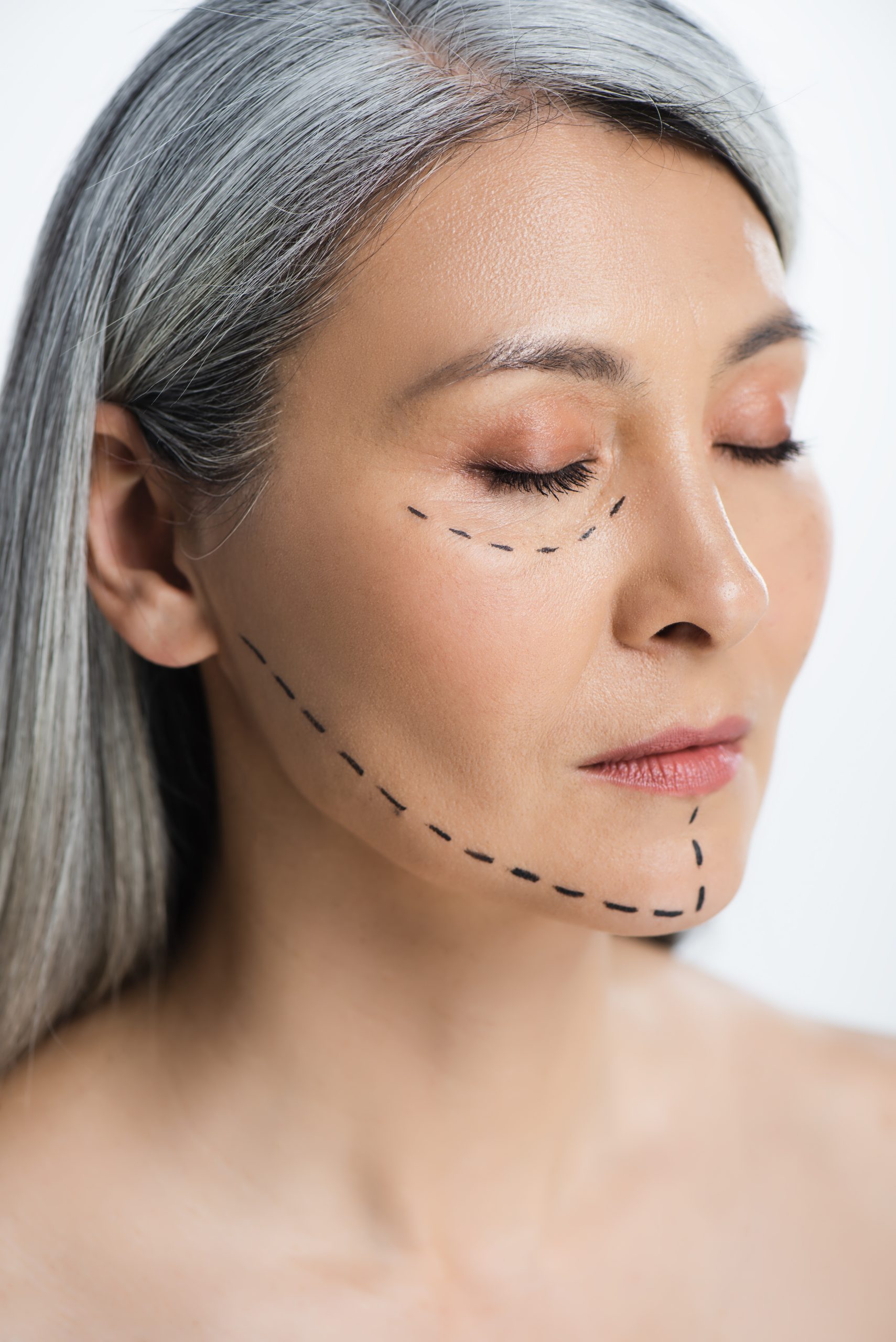 facelift recovery