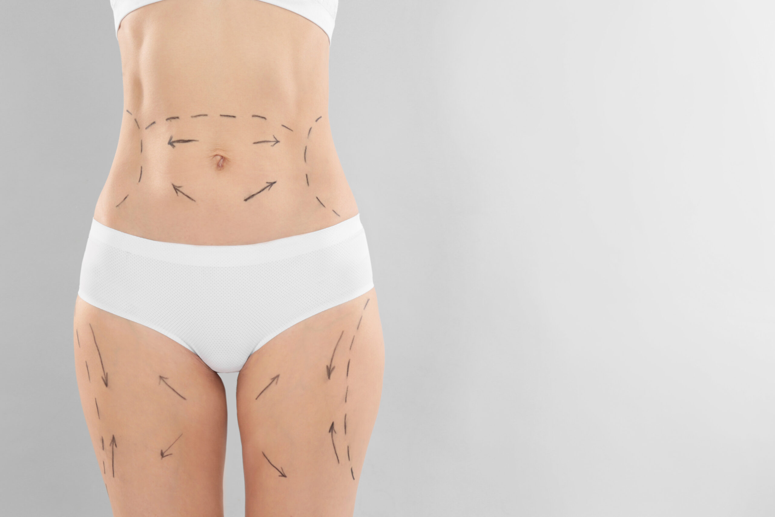 Who Is a Good Candidate for VASER Lipo?
