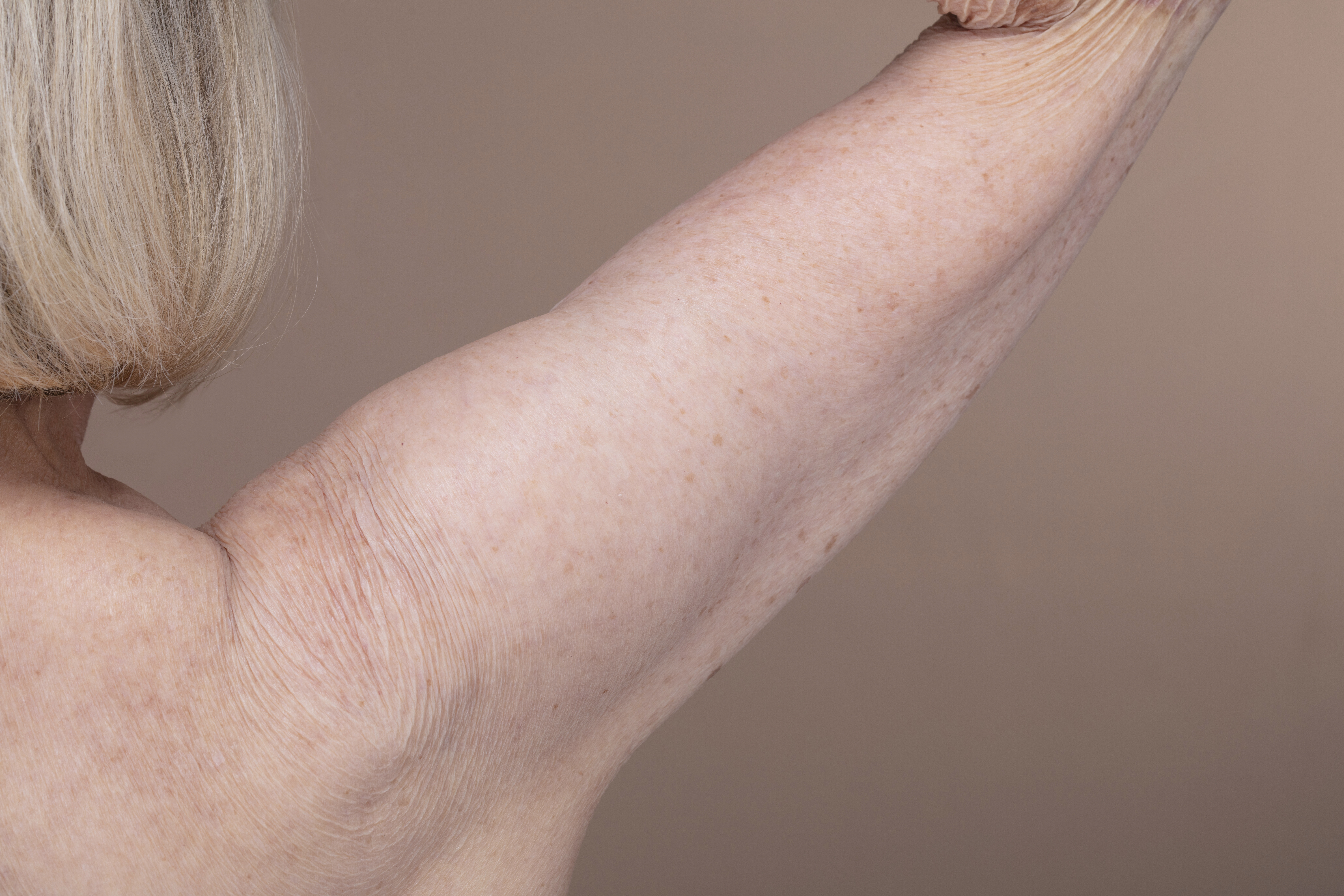 Brachioplasty: Reshaping Sagging Upper Arms at Adnova Clinic 