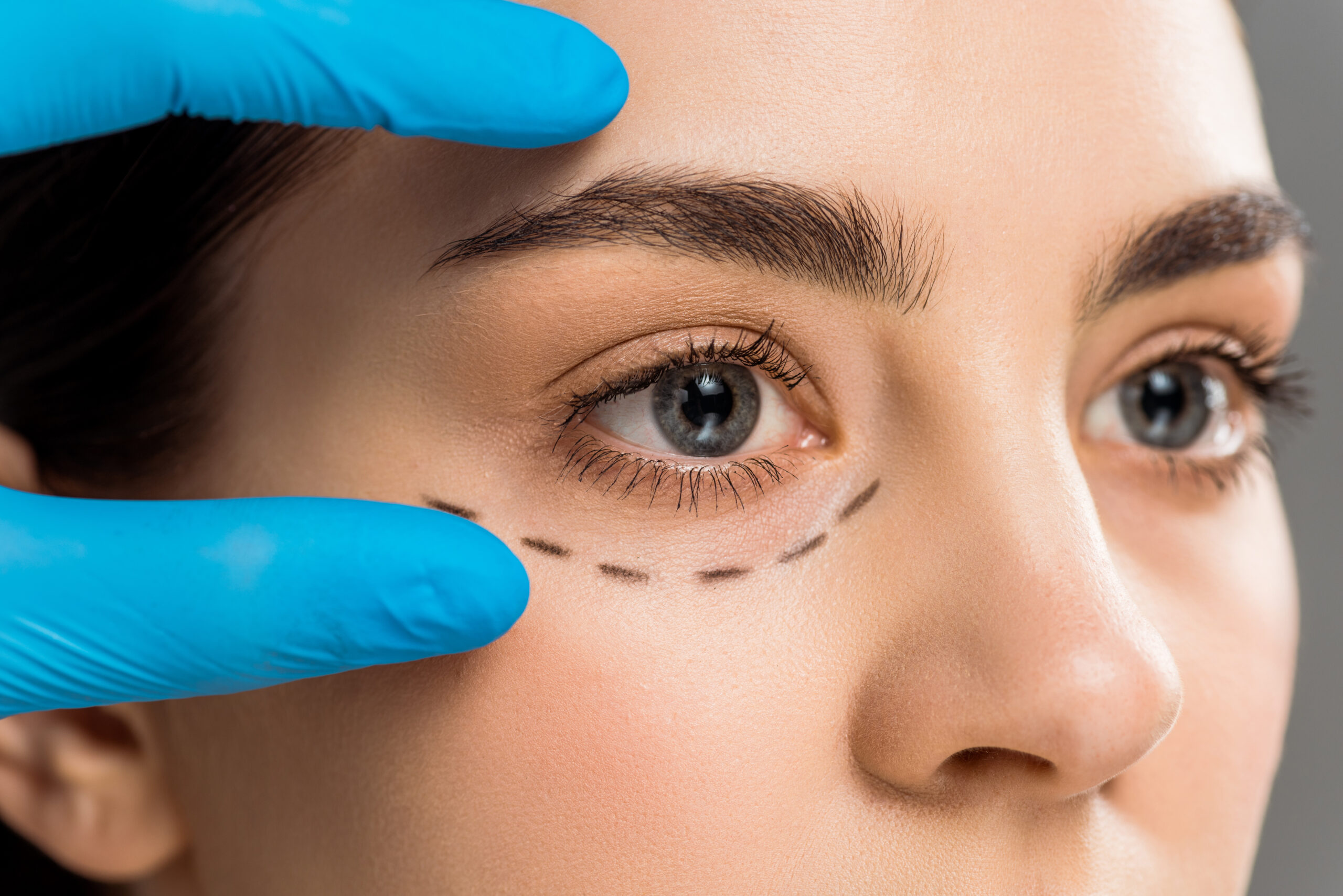 What is Blepharoplasty? Revitalising Tired Eyes with Eyelid Surgery at Adnova Clinic